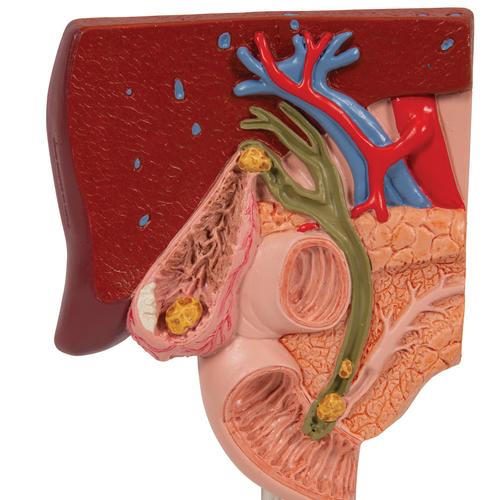 Gallstone Model - 3B Smart Anatomy, 1000314 [K26], Digestive System Models