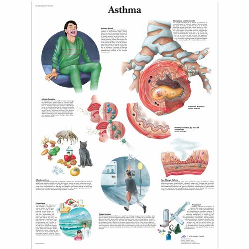 Asthma Chart, 4006677 [VR1328UU], Asthma and Allergies Education