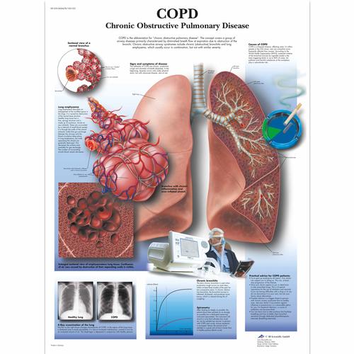 COPD Chart - Chronic Obstructive Pulmonary Disease, 4006678 [VR1329UU], Tobacco Education