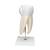 Giant Molar with Dental Cavities Human Tooth Model, 15 times Life-Size, 6 part - 3B Smart Anatomy, 1013215 [D15], Dental Models (Small)