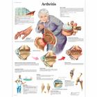 Arthritis Chart, 1001474 [VR1123L], Arthritis and Osteoporosis Education